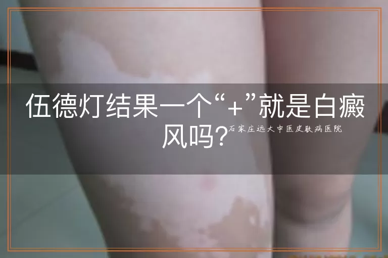 伍德灯结果一个“+”就是白癜风吗?