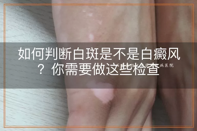 如何判断白斑是不是白癜风？你需要做这些检查