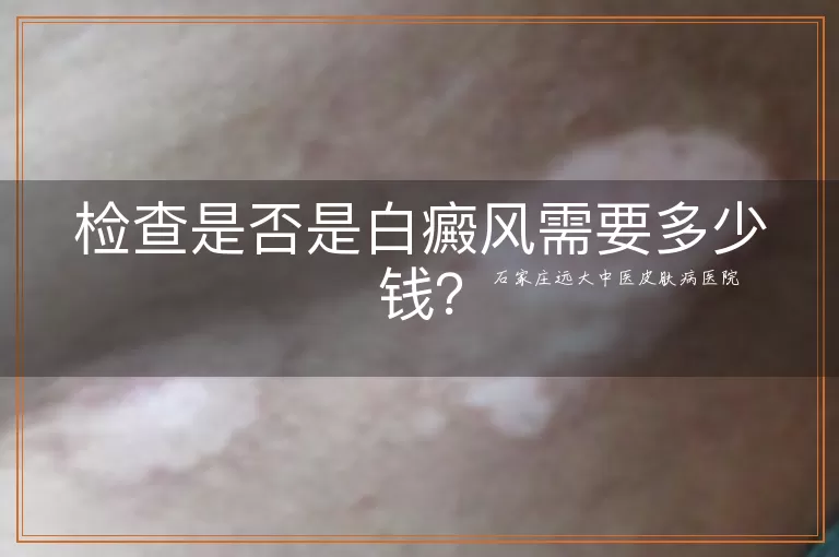检查是否是白癜风需要多少钱？