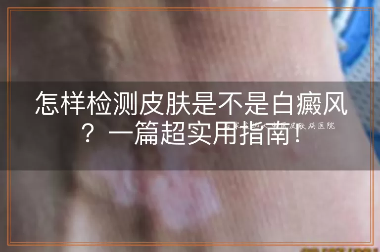 怎样检测皮肤是不是白癜风？一篇超实用指南！