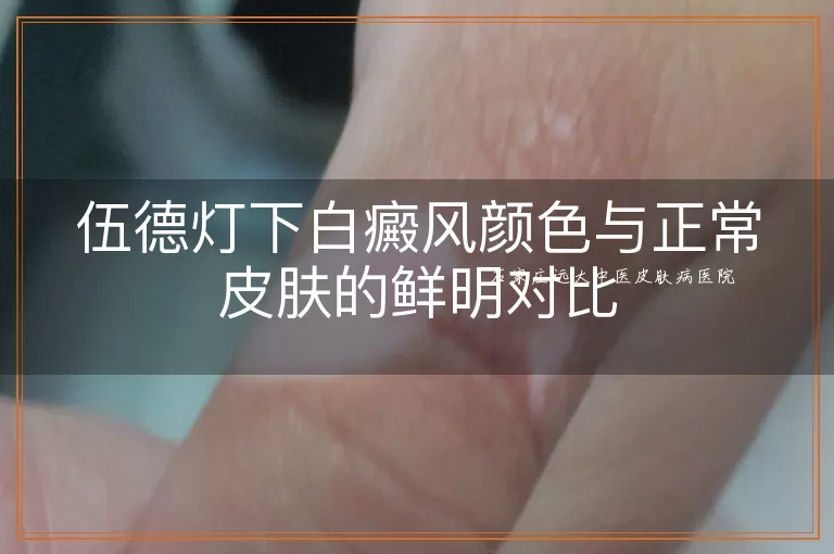 伍德灯下白癜风颜色与正常皮肤的鲜明对比