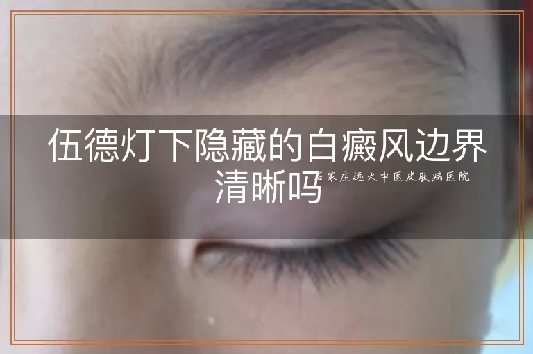 伍德灯下隐藏的白癜风边界清晰吗