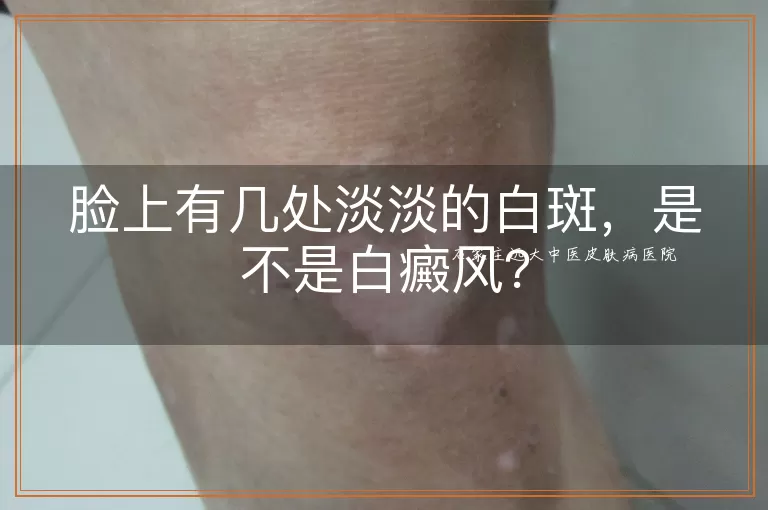 脸上有几处淡淡的白斑，是不是白癜风？
