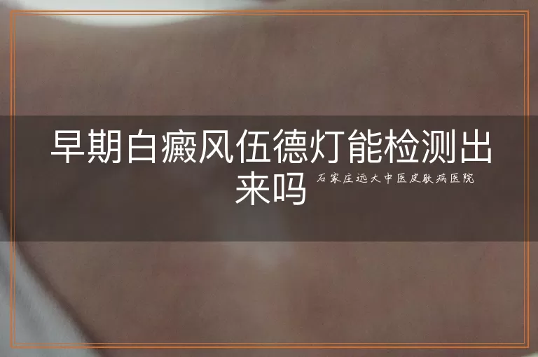 早期白癜风伍德灯能检测出来吗