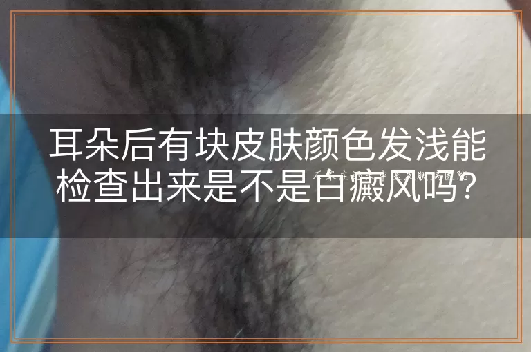 耳朵后有块皮肤颜色发浅能检查出来是不是白癜风吗？