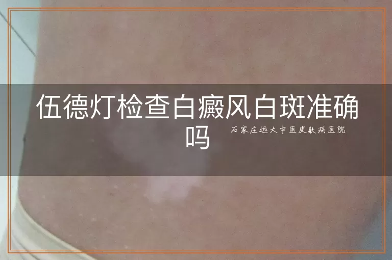 伍德灯检查白癜风白斑准确吗