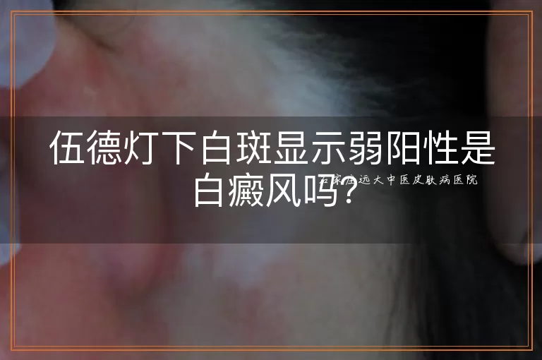 伍德灯下白斑显示弱阳性是白癜风吗？