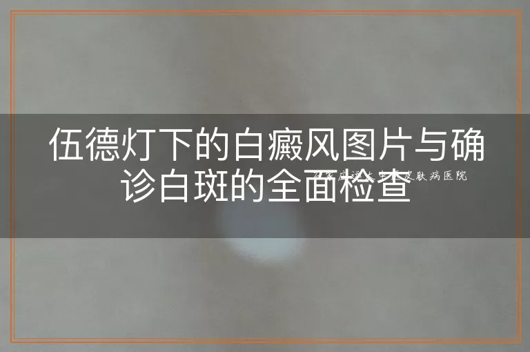 伍德灯下的白癜风图片与确诊白斑的全面检查