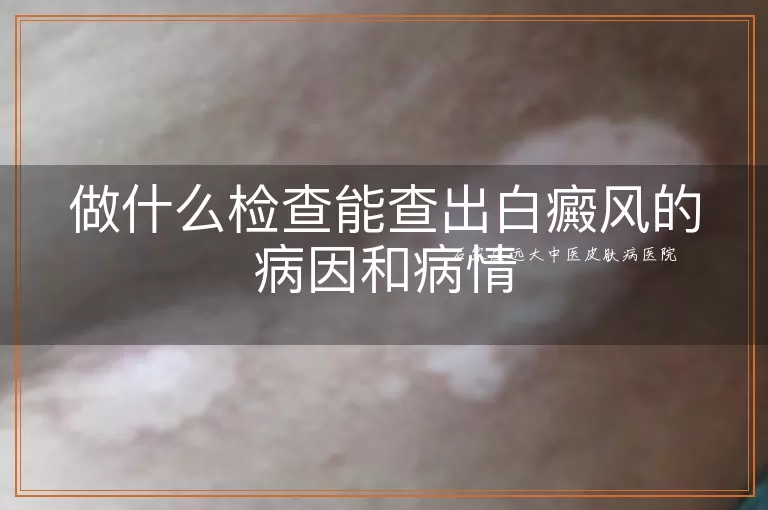 做什么检查能查出白癜风的病因和病情