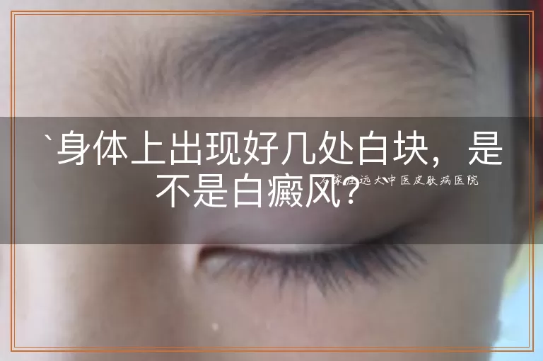 身体上出现好几处白块，是不是白癜风？