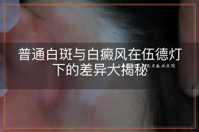 普通白斑与白癜风在伍德灯下的差异大揭秘