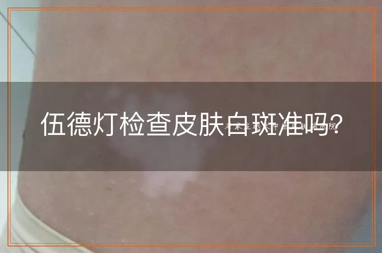 伍德灯检查皮肤白斑准吗？