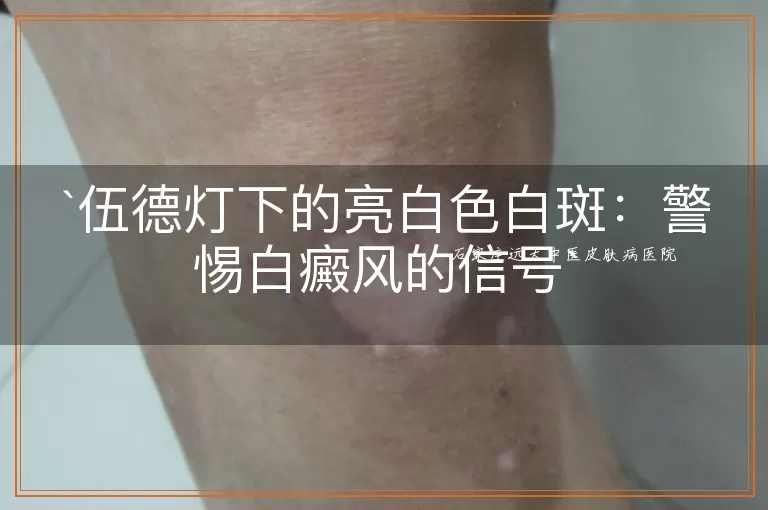 伍德灯下的亮白色白斑：警惕白癜风的信号