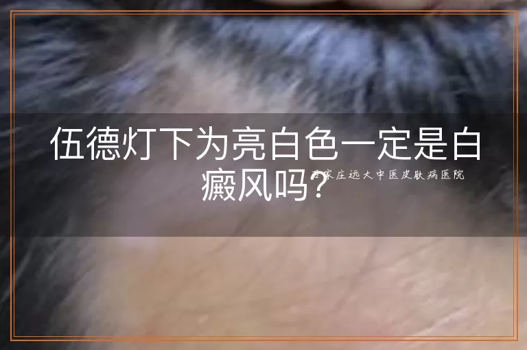 伍德灯下为亮白色一定是白癜风吗？