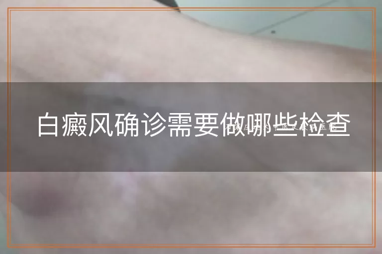 白癜风确诊需要做哪些检查