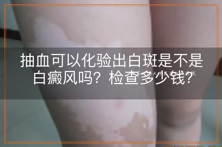 抽血可以化验出白斑是不是白癜风吗？检查多少钱？