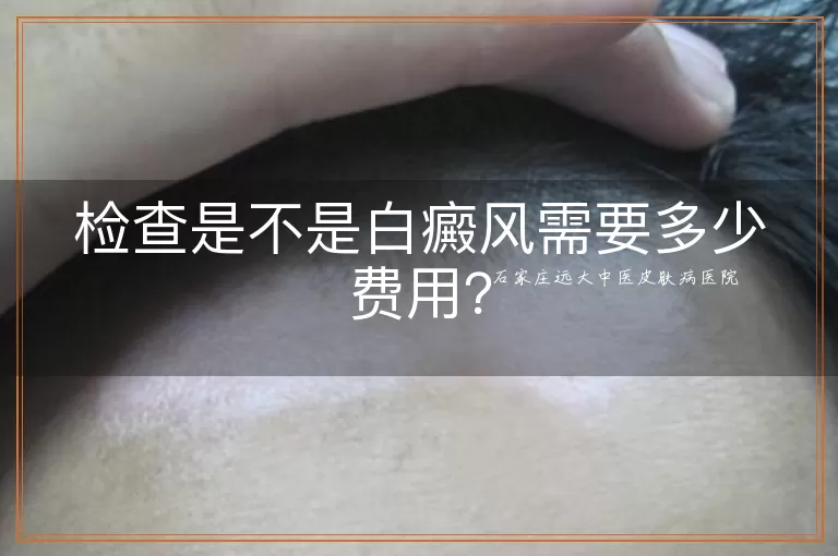 检查是不是白癜风需要多少费用?