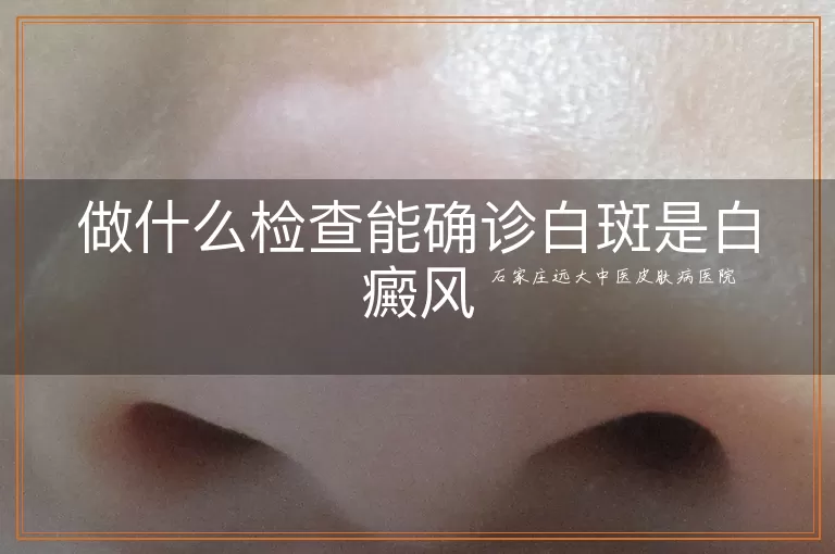 做什么检查能确诊白斑是白癜风