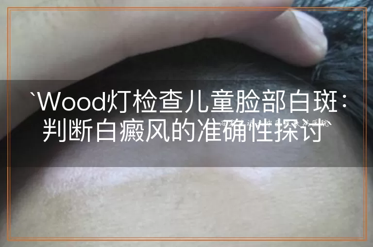 Wood灯检查儿童脸部白斑：判断白癜风的准确性探讨