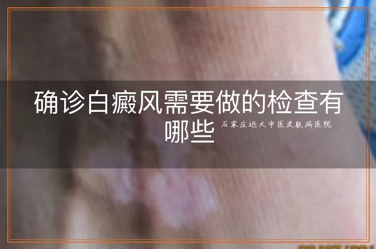 确诊白癜风需要做的检查有哪些