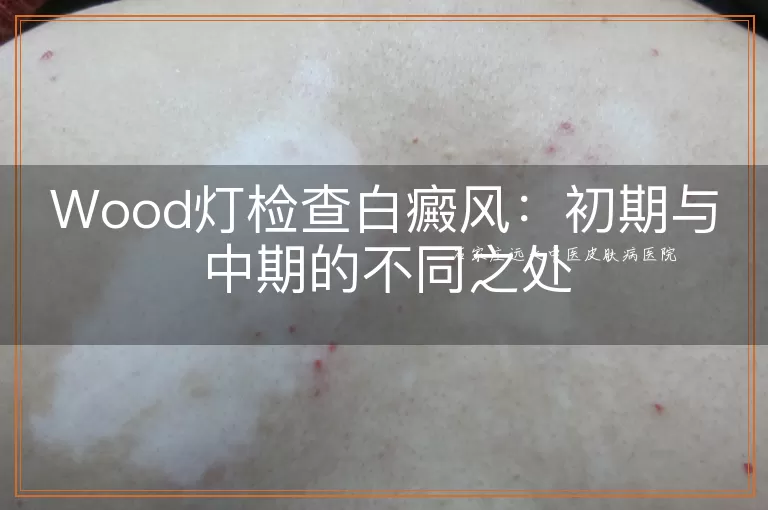 Wood灯检查白癜风：初期与中期的不同之处