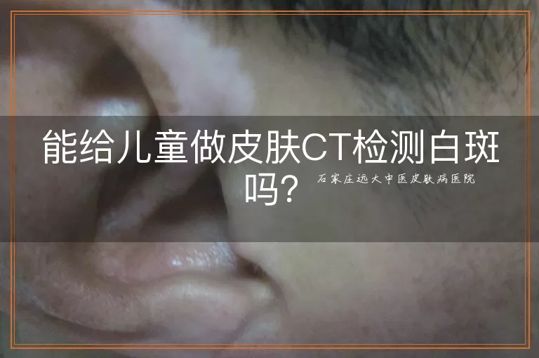 能给儿童做皮肤CT检测白斑吗？