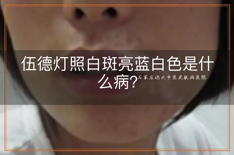 伍德灯照白斑亮蓝白色是什么病？