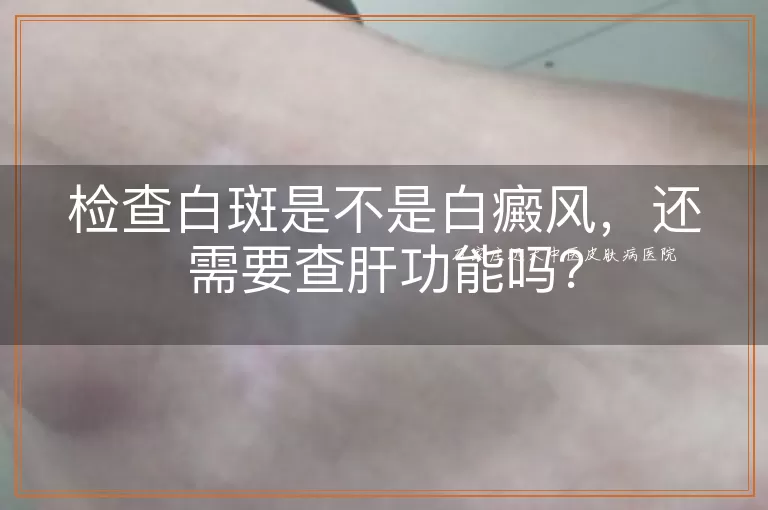 检查白斑是不是白癜风，还需要查肝功能吗？