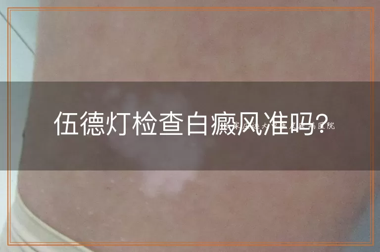 伍德灯检查白癜风准吗？