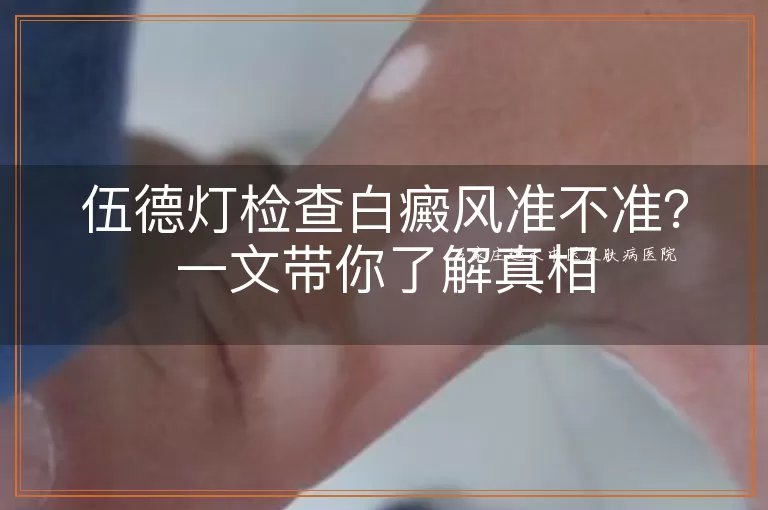 伍德灯检查白癜风准不准？一文带你了解真相