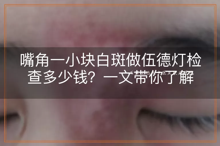 嘴角一小块白斑做伍德灯检查多少钱？一文带你了解