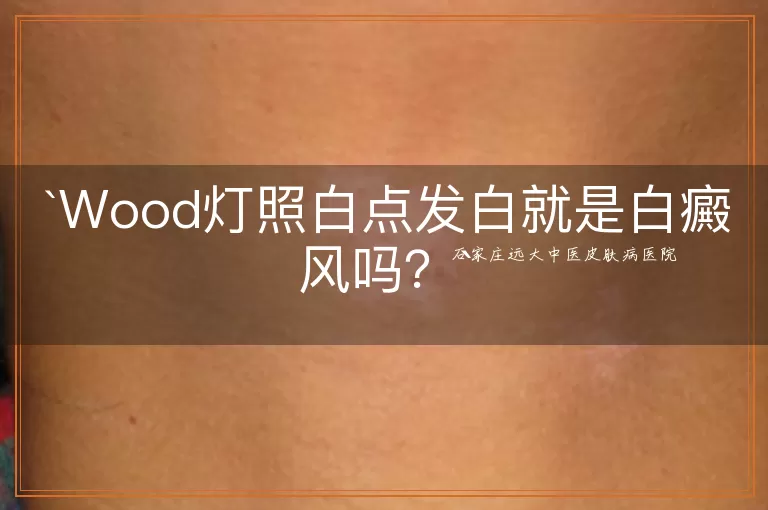 Wood灯照白点发白就是白癜风吗？