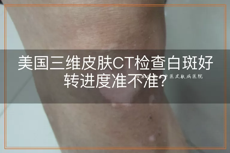 美国三维皮肤CT检查白斑好转进度准不准？