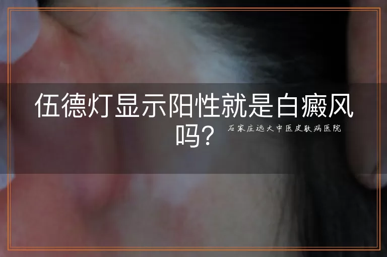 伍德灯显示阳性就是白癜风吗？