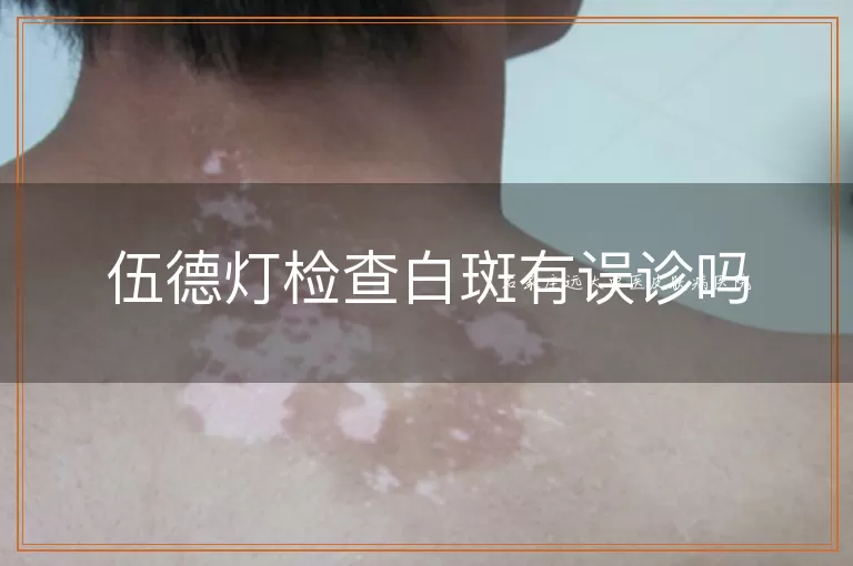 伍德灯检查白斑有误诊吗