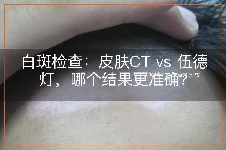 白斑检查：皮肤CT vs 伍德灯，哪个结果更准确？