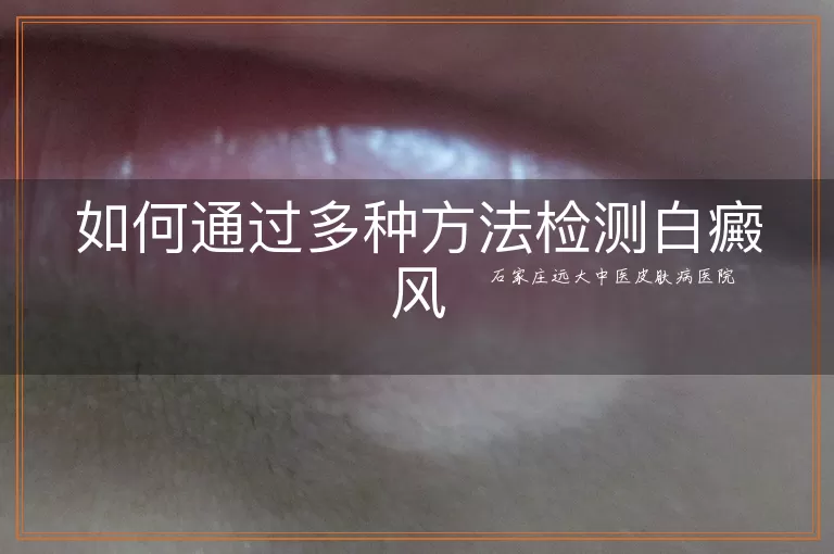 如何通过多种方法检测白癜风