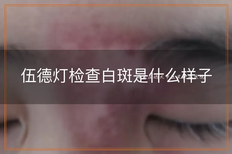 伍德灯检查白斑是什么样子