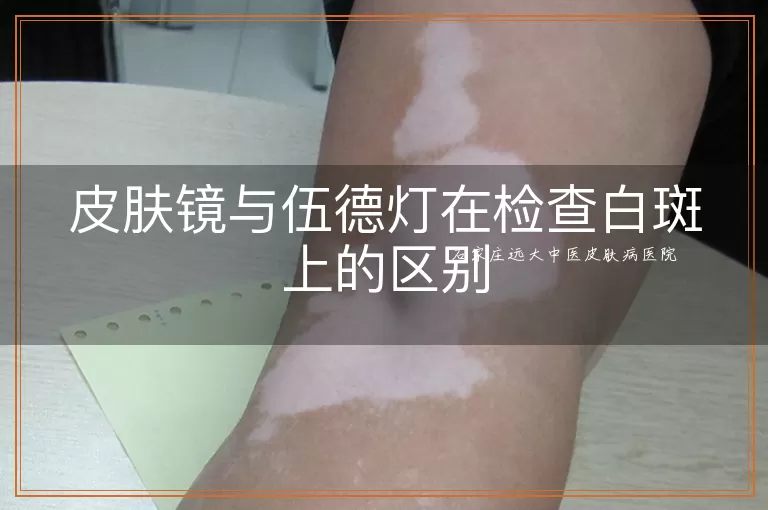 皮肤镜与伍德灯在检查白斑上的区别