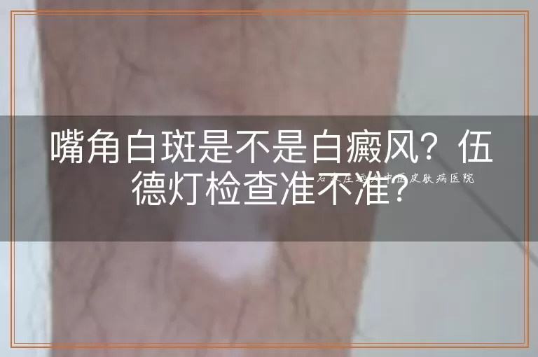 嘴角白斑是不是白癜风？伍德灯检查准不准？