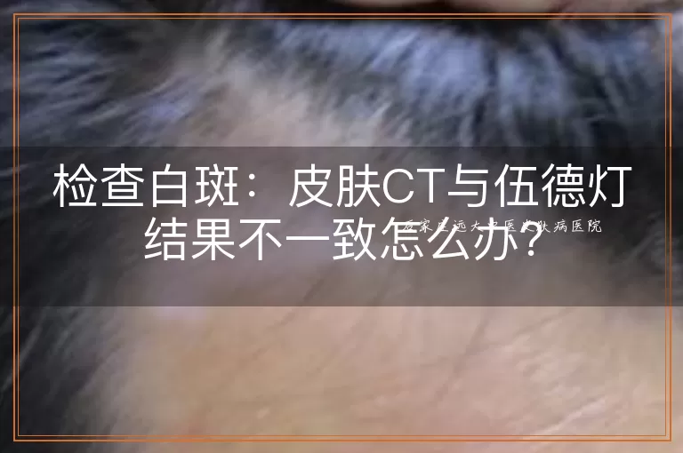 检查白斑:皮肤CT与伍德灯结果不一致怎么办?