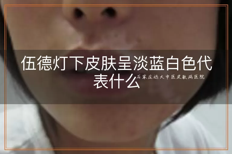 伍德灯下皮肤呈淡蓝白色代表什么