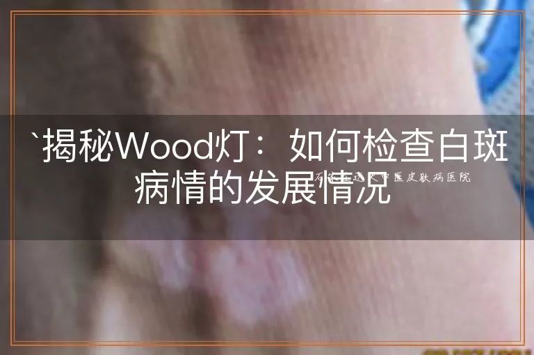 揭秘Wood灯：如何检查白斑病情的发展情况