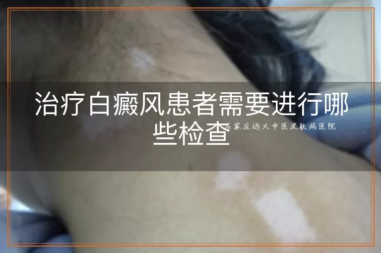 治疗白癜风患者需要进行哪些检查