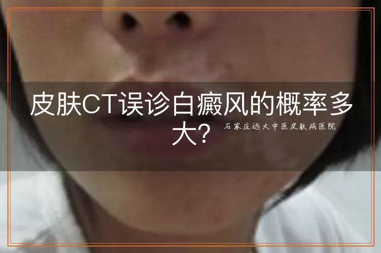 皮肤CT误诊白癜风的概率多大？