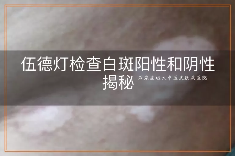 伍德灯检查白斑阳性和阴性揭秘