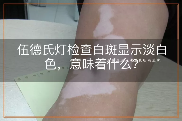 伍德氏灯检查白斑显示淡白色，意味着什么？
