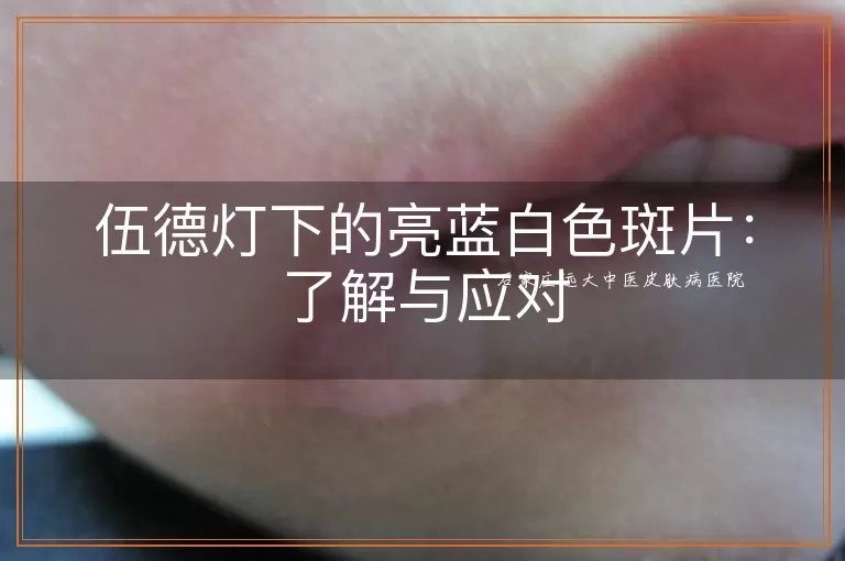 伍德灯下的亮蓝白色斑片：了解与应对