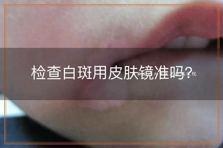 检查白斑用皮肤镜准吗？