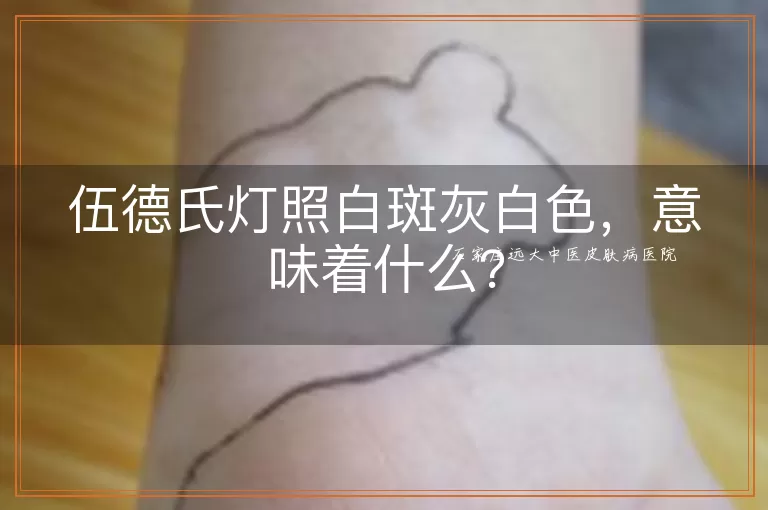 伍德氏灯照白斑灰白色，意味着什么？